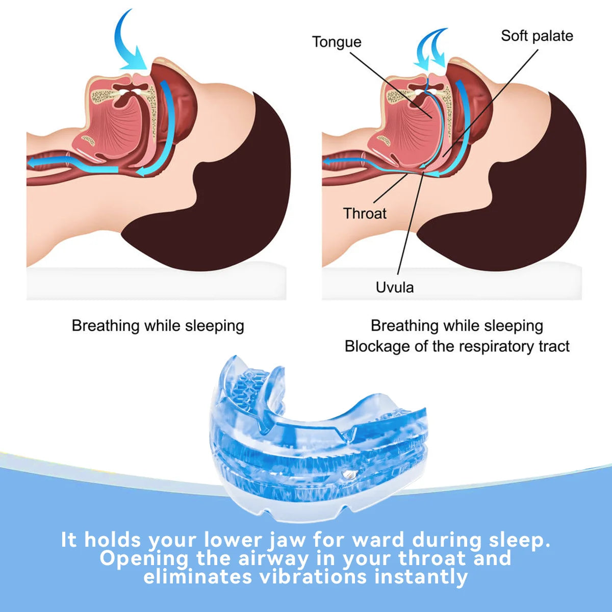 SNOREGUARD – Anti-Snoring Mouthpiece for Comfortable Sleep