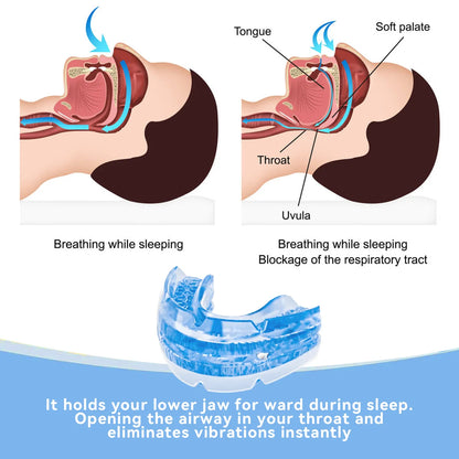 SNOREGUARD – Anti-Snoring Mouthpiece for Comfortable Sleep