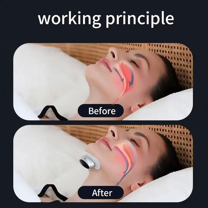 SNOREASE – Electric Anti-Snoring Device for Peaceful Sleep